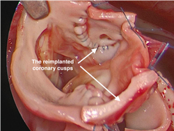 coronary cusps are reimplanted into the neoaorta