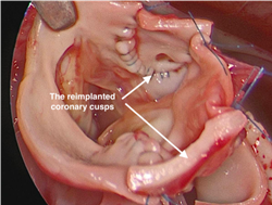 Los velos coronarios se implantan en la aorta del neonato